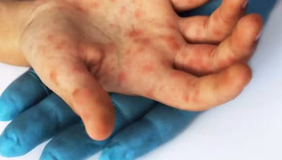 Ministerio de Salud reporta primer caso de viruela del mono en Piura