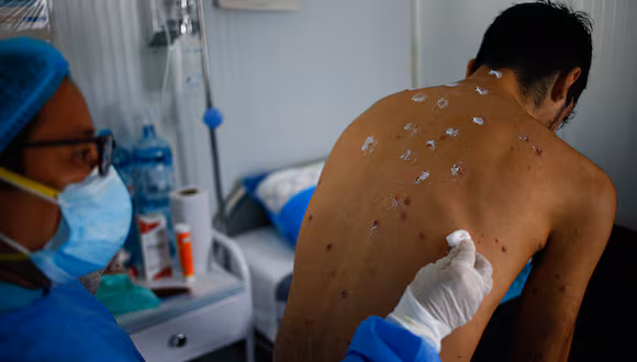 Huancayo: Especialista recomienda higiene extrema y distancia para evitar viruela del mono